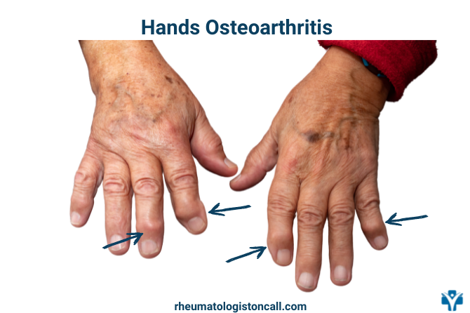 How To Treat Hand Osteoarthritis At Home Rheumatologist Oncall Inflammatory Arthritis 5853
