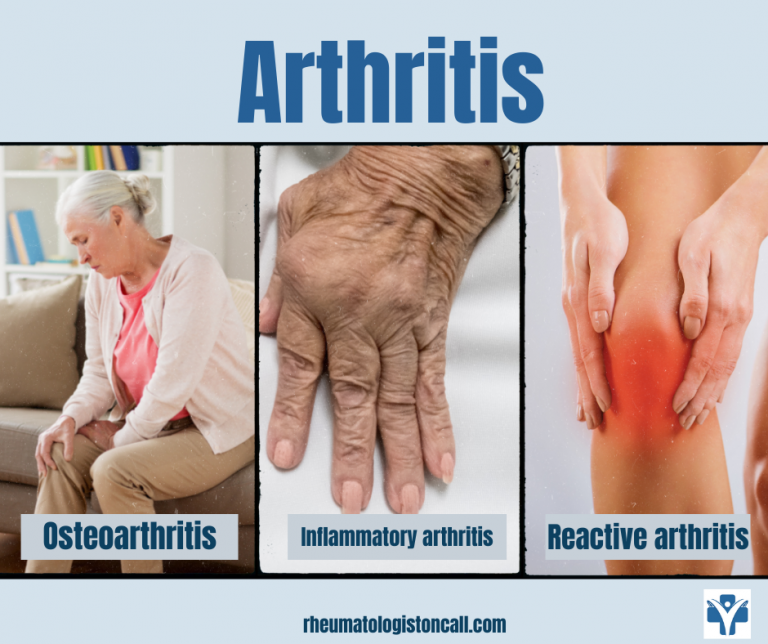 Common types of arthritis: reactive, autoimmune and degenerative ...