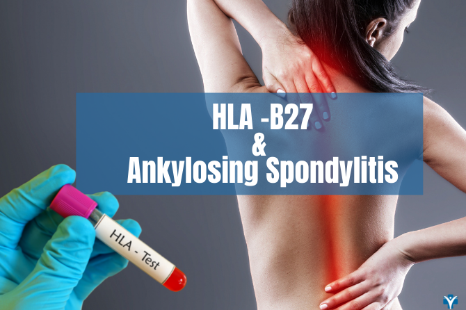 Ankylosing Spondylitis -Is HLA-B27 essential for diagnosis?