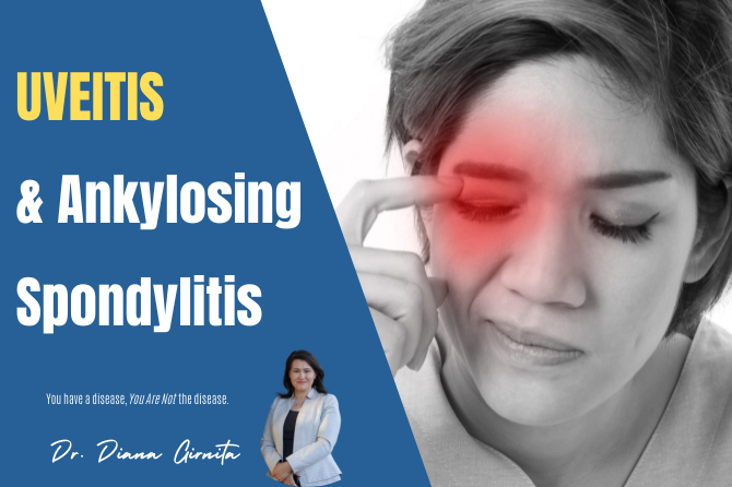 How Does Ankylosing Spondylitis Affect Your Eyes?