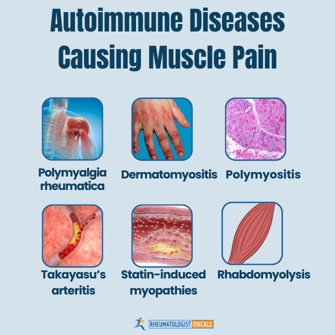 muscle-pain-in-autoimmune-diseases-rheumatologist-oncall