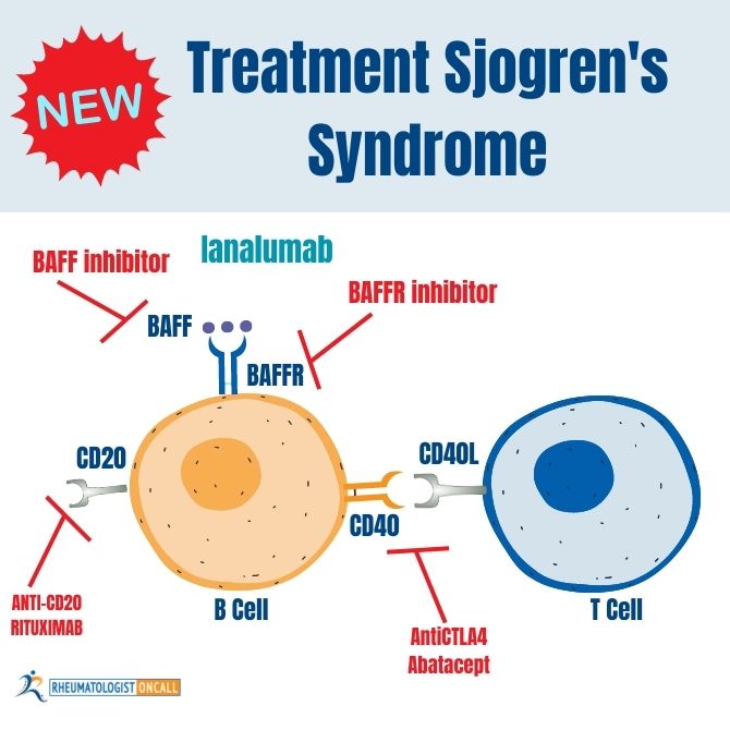 New Treatment For Sjogren's Syndrome
