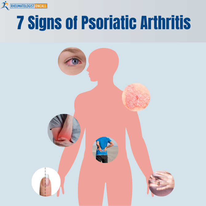 psoriatic arthritis
