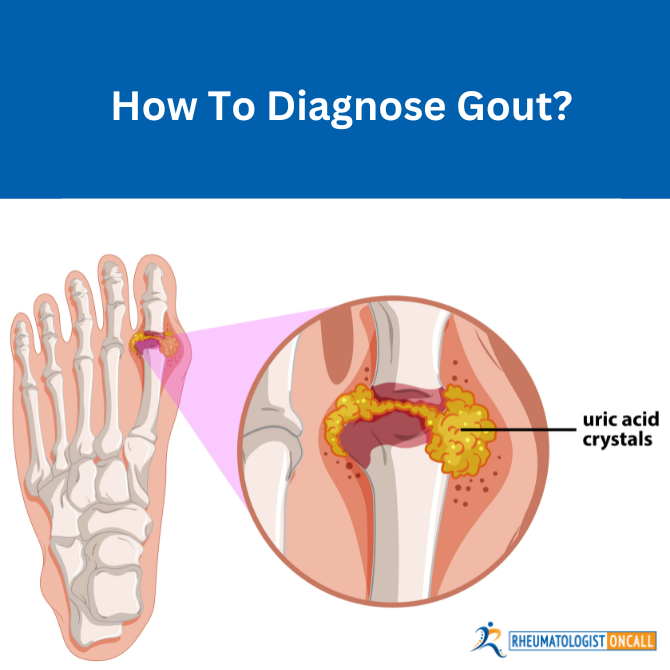 how to diagnose gout
