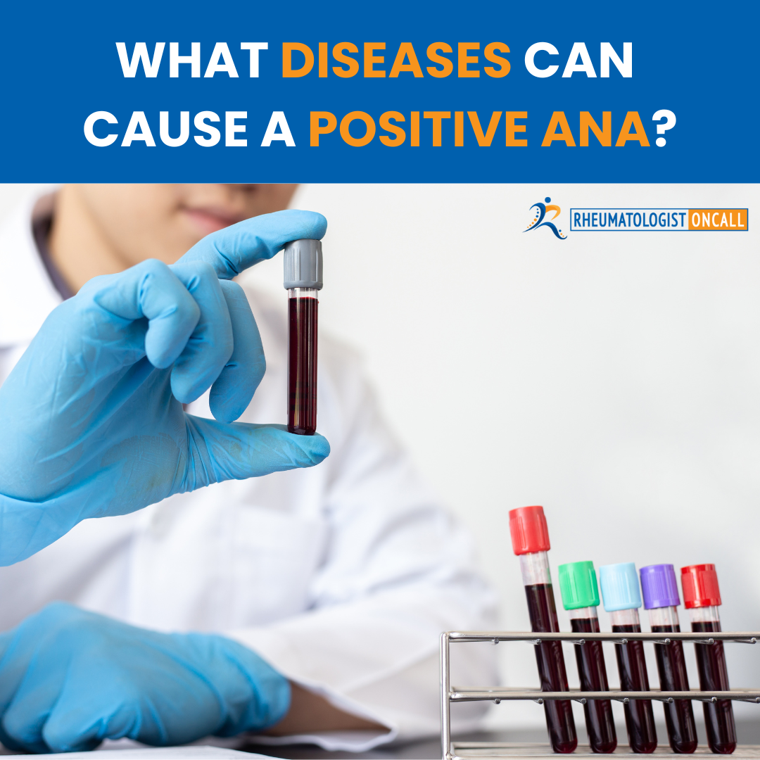 what diseases can cause a positive ana