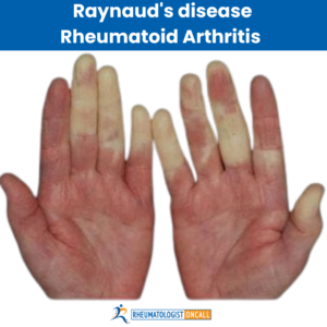 raynaud's disease