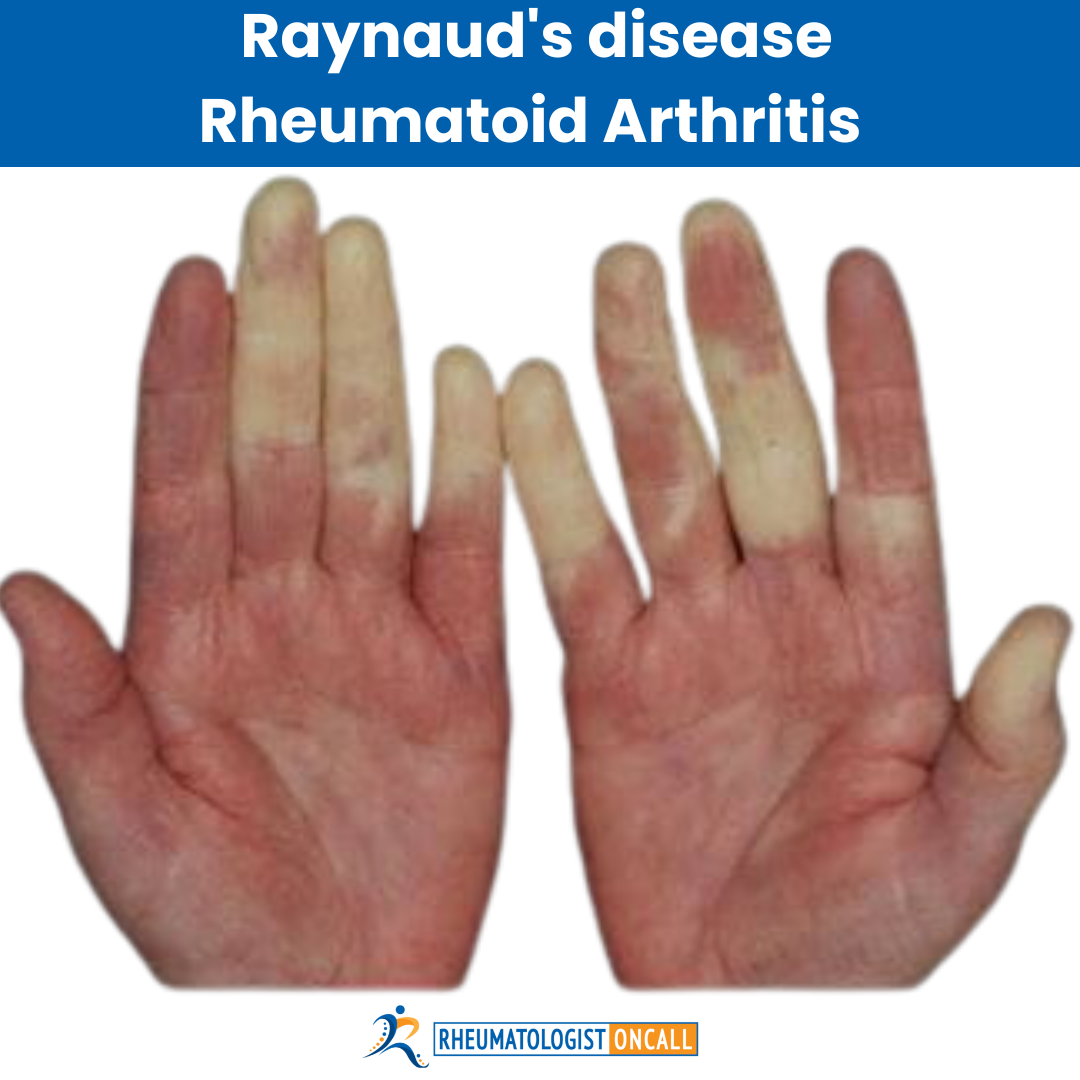 10 Uncommon Signs of Rheumatoid Arthritis