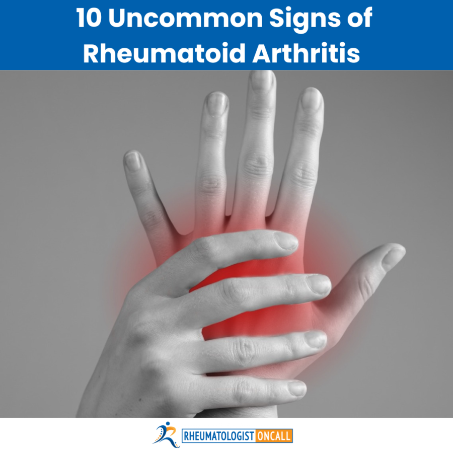 10 Uncommon Signs of Rheumatoid Arthritis