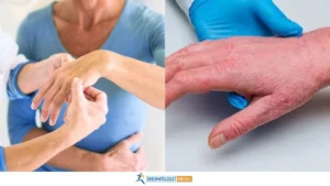 rheumatoid arthritis vs psoriatic arthritis