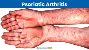 rheumatoid arthritis vs psoriatic arthritis