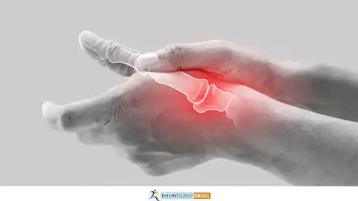 rheumatoid-arthritis-joints