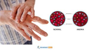 rheumatoid arthritis and anemia