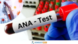 Featured image for blog "COVID-19 and positive ana test"