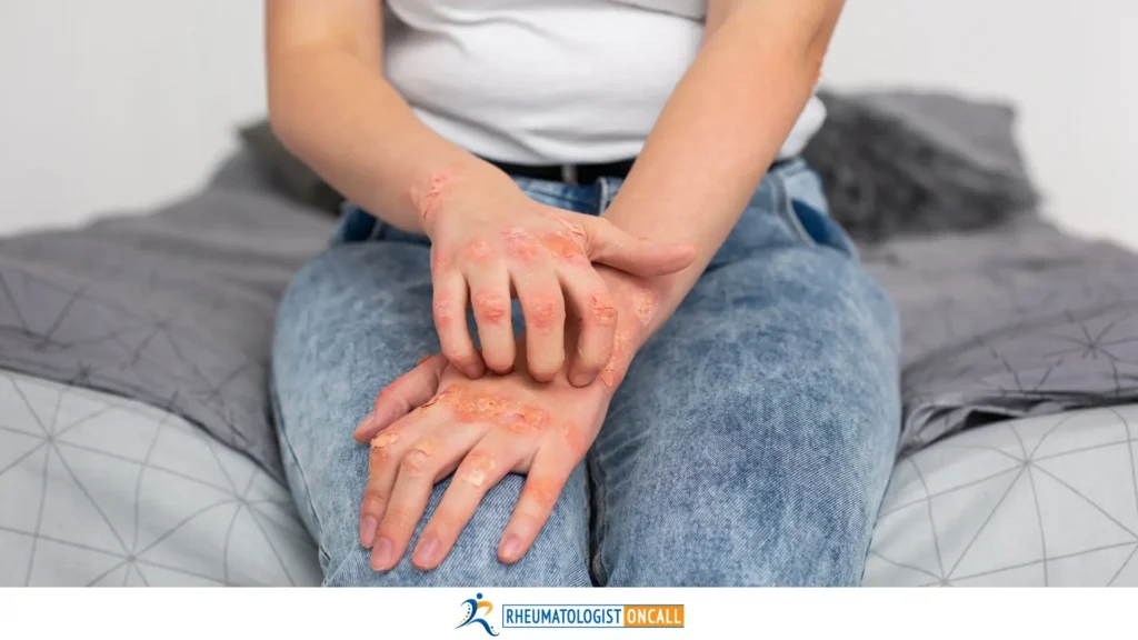 Featured image for "Psoriatic Arthritis Flares: Triggers, Managing Symptoms, and How to Prevent Recurrence?" for "https://rheumatologistoncall.com/"